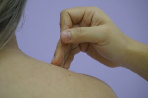 CNN Brasil: Acupuntura pode diminuir efeitos secundários da terapia anti-hormonal para câncer de mama